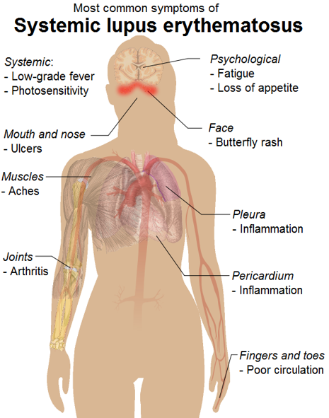 Illustration showing body systems that can be affected by lupus